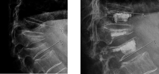 Minimal invasive Behandlung von Wirbelfrakturen